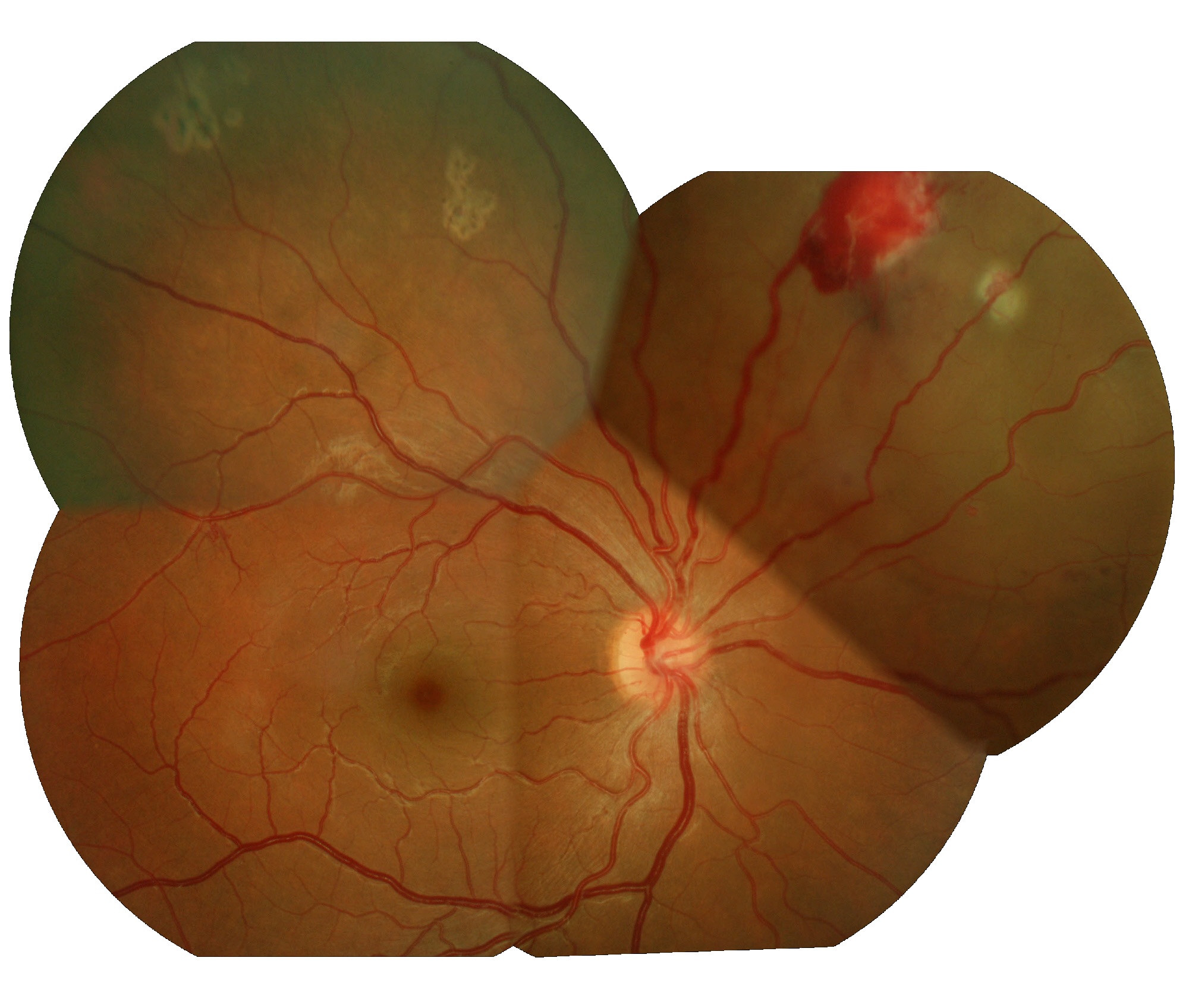Retinopatia Von Hippel Lindau