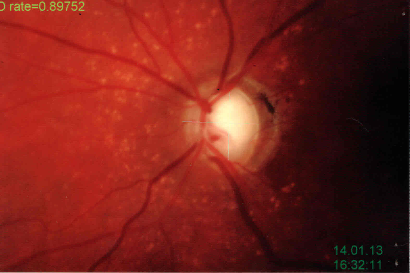 Atrofia corioretinica al polo posteriore