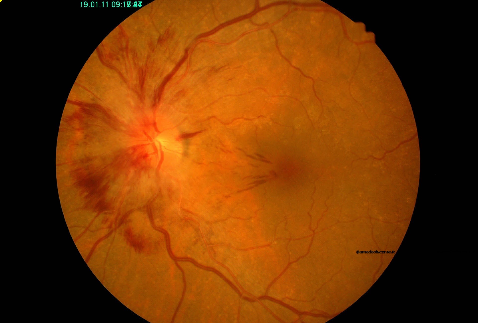 Occlusione Vascolare Venosa Retinica