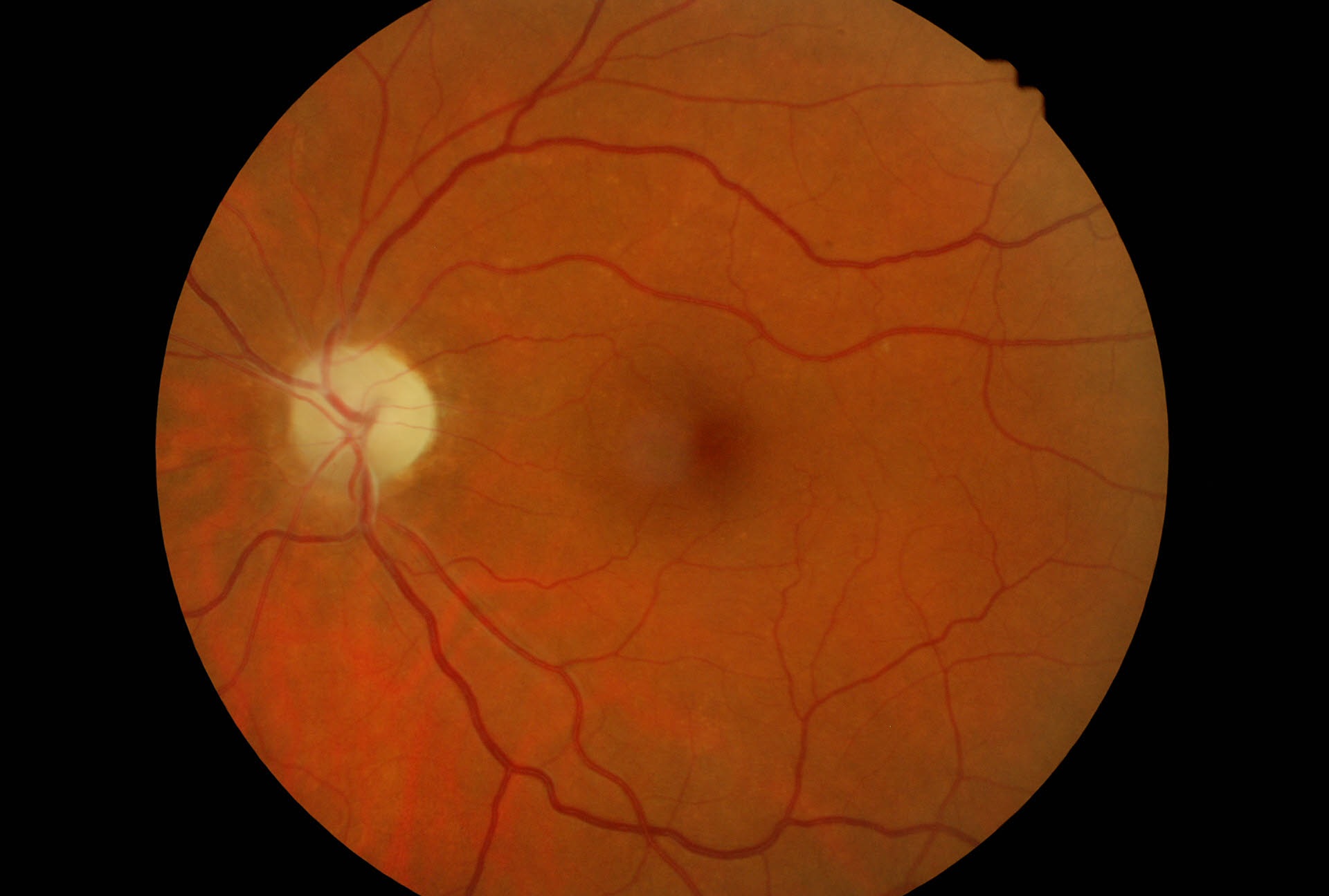 Neoplasia orbitaria con atrofia secondaria del  nervo ottico
