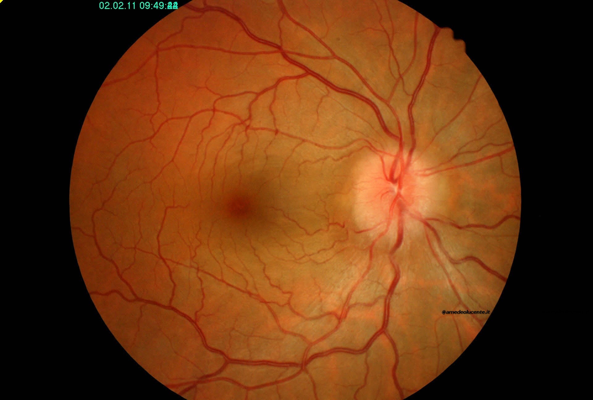 Papilla Ottica Rilevata sul piano retinico