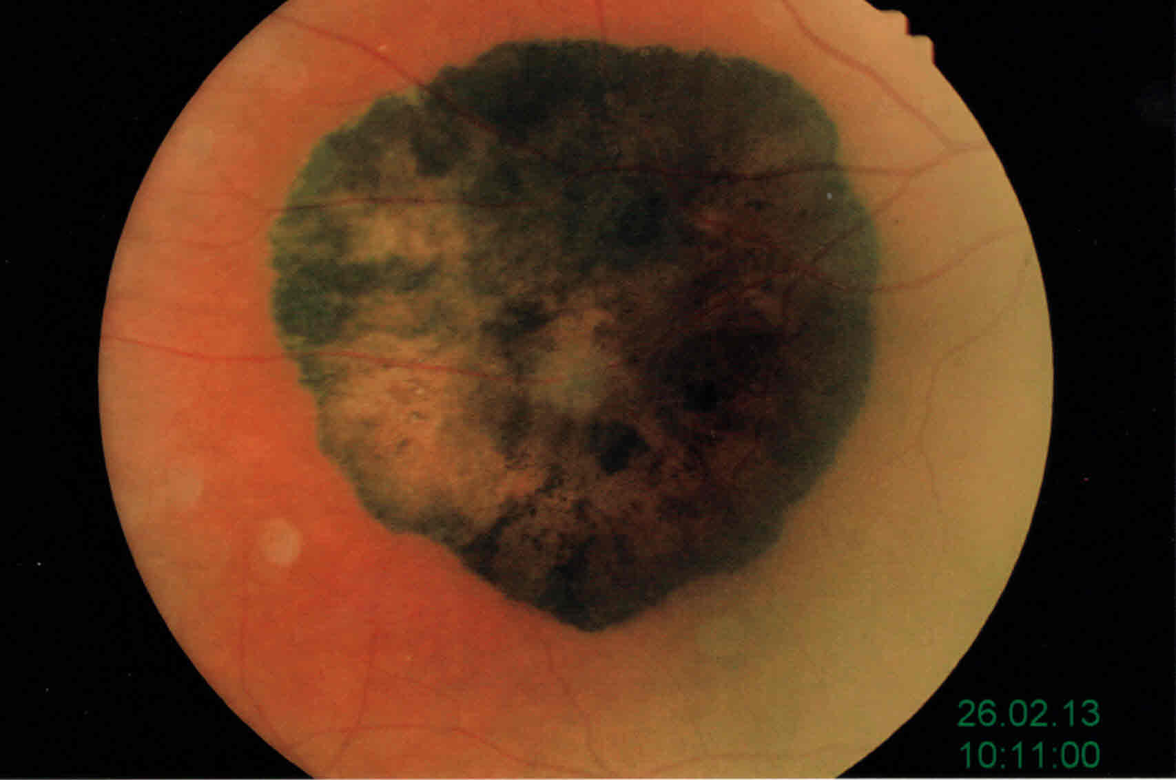 Iperplasia EPR