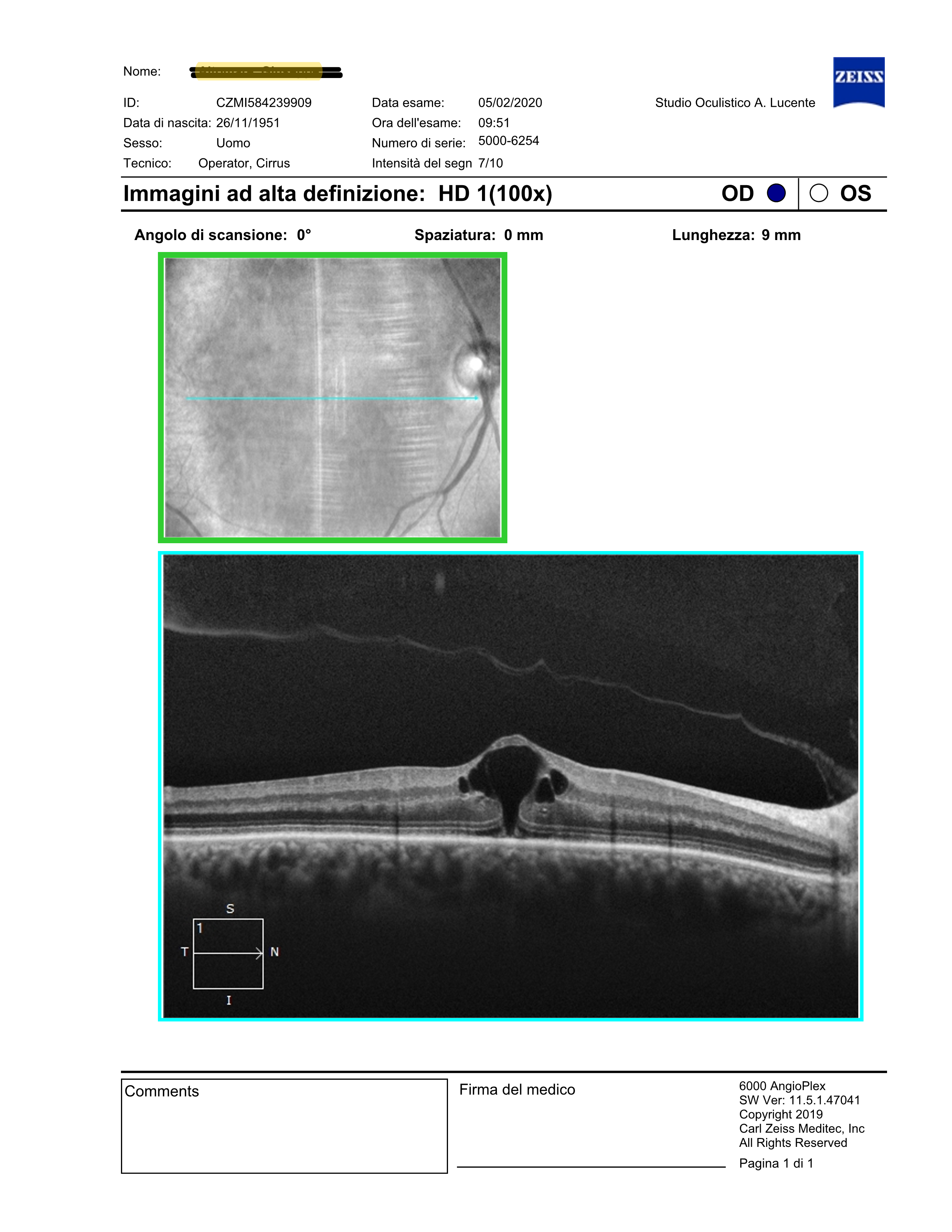 Edema cistoide risolto dopo un anno con deficit fotorecettori