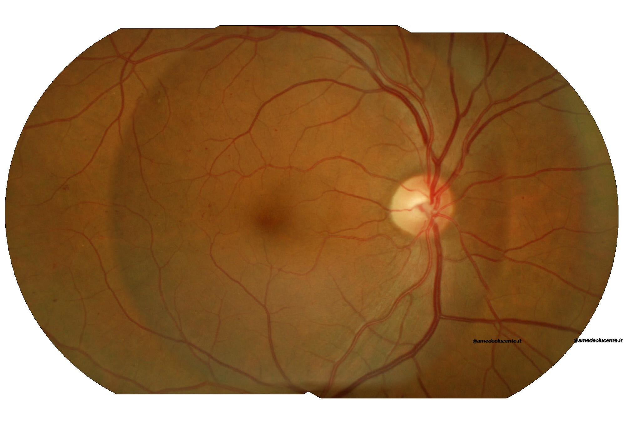 Retinopatia Diadetica