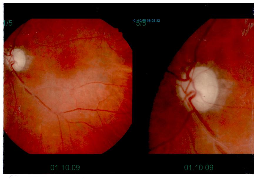 Glaucoma terminale con cataratta nigra nell'occhio adelfo
