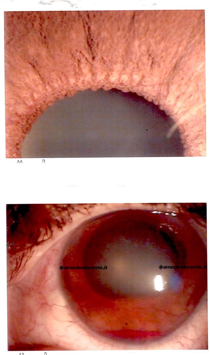 Glaucoma neovascolare