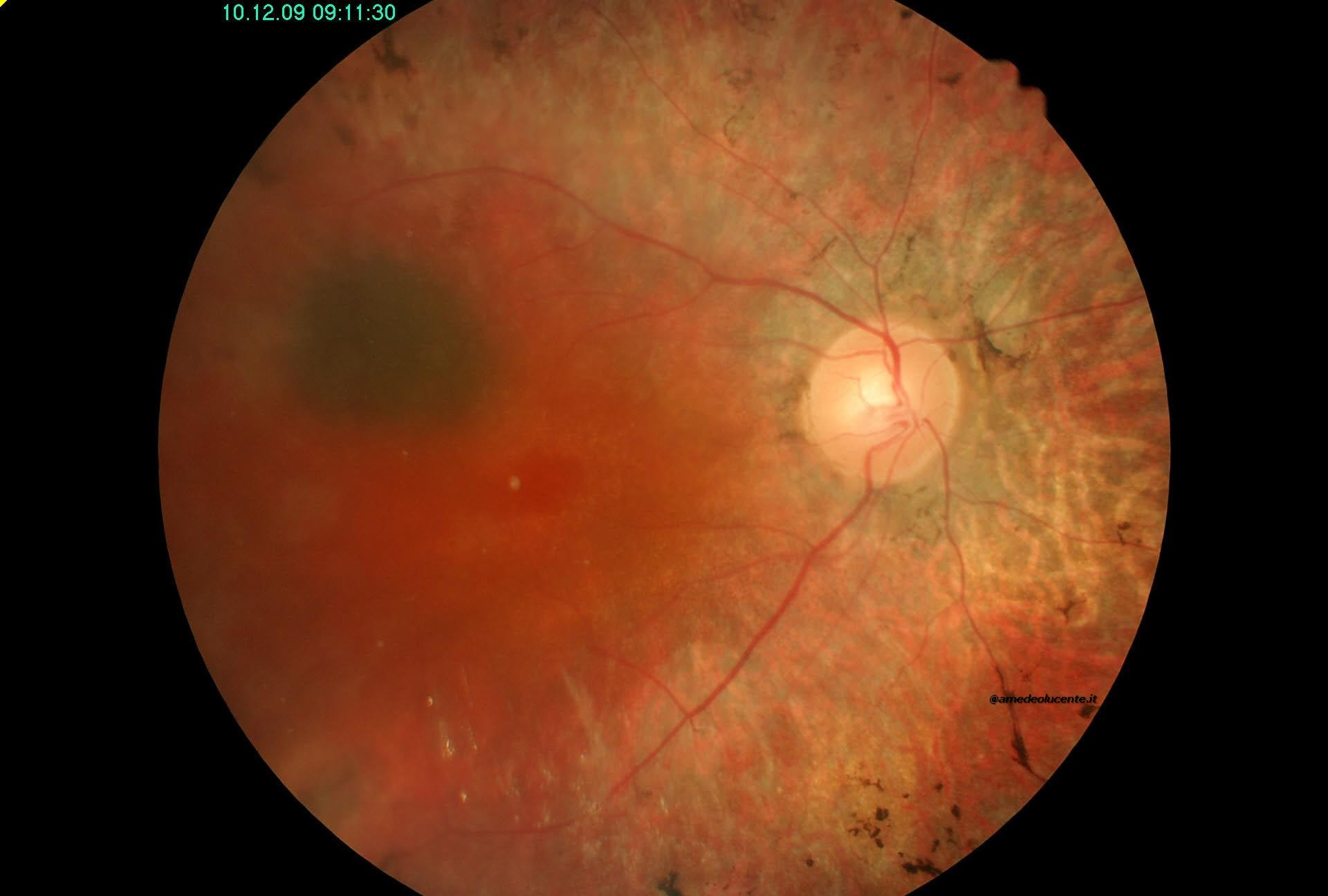 Retinopatia Pigmentosa con nevo coroideale