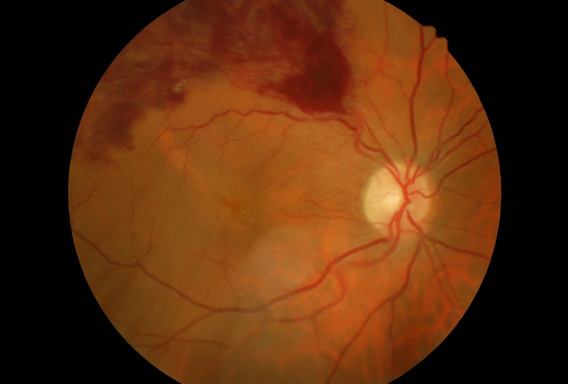 Occlusione di branca venosa retinica