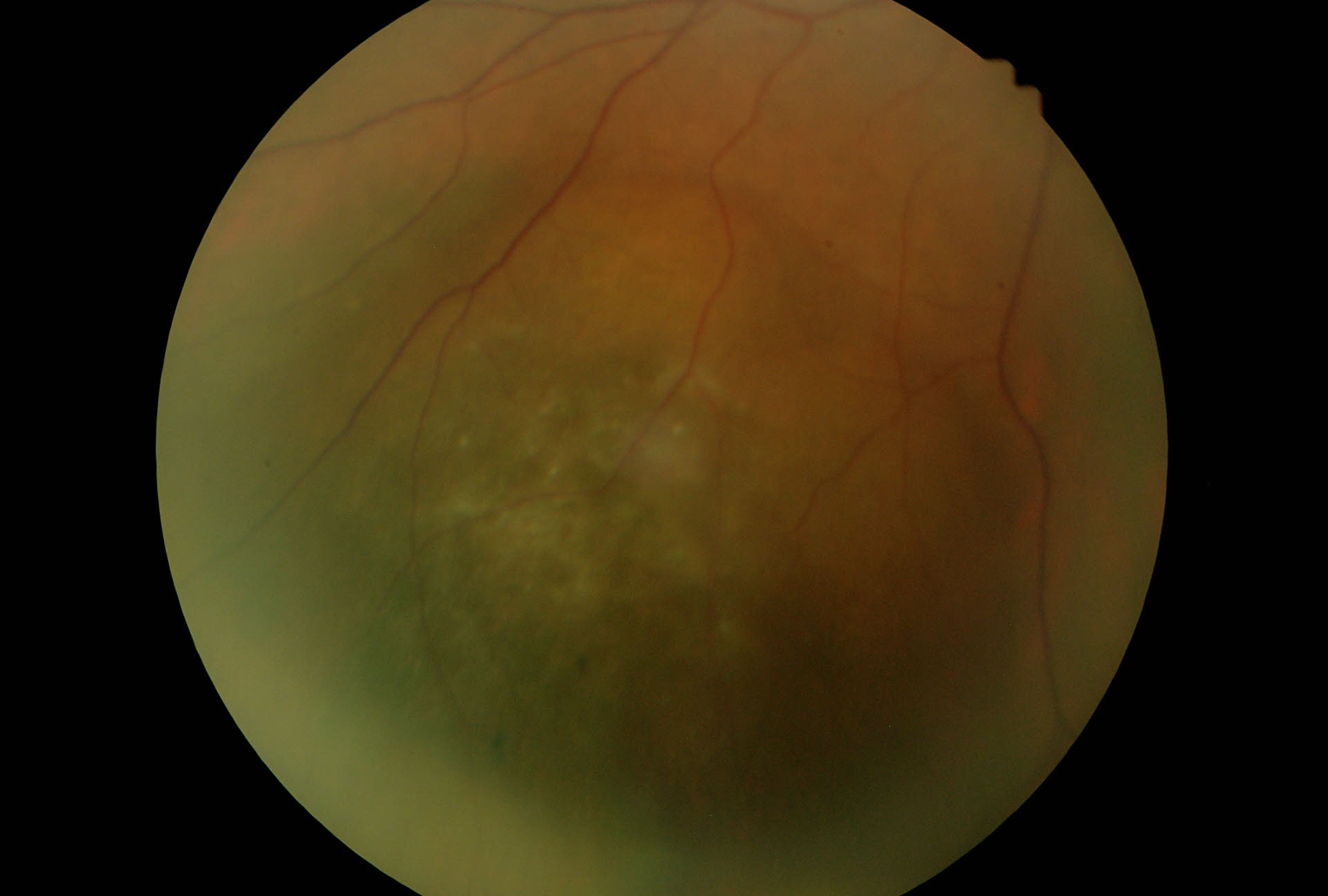 Sospetto melanoma della coroide