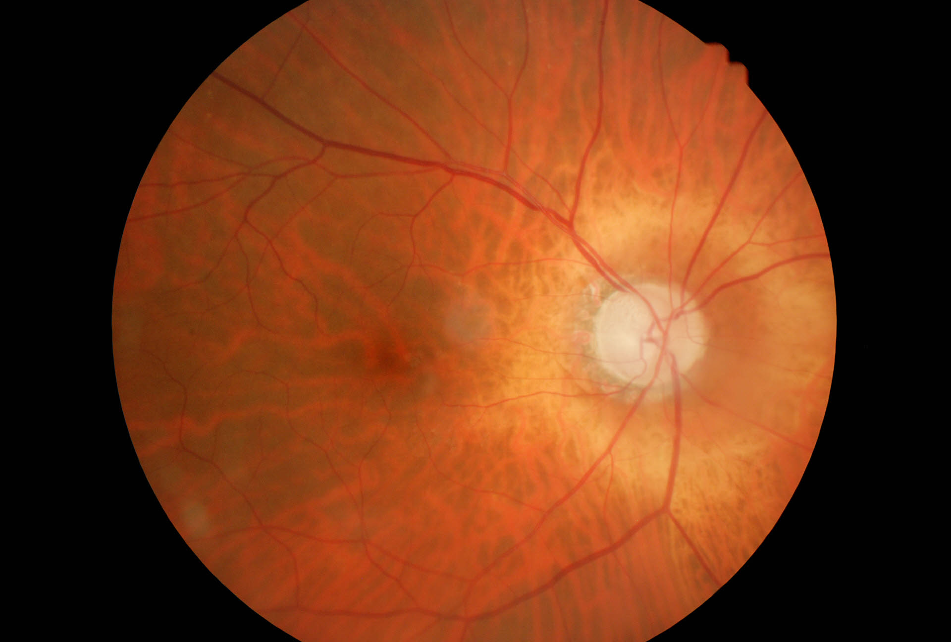 Glaucoma peripapillare Prima Parte