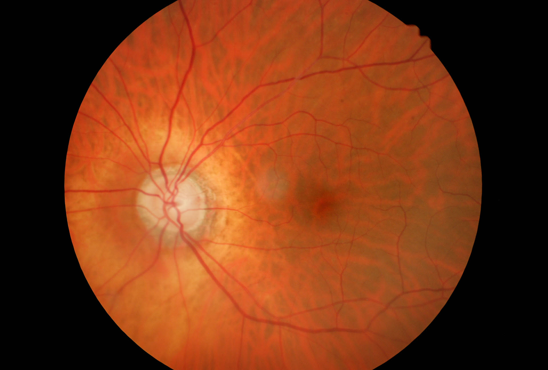 Glaucoma peripapillare Prima Parte